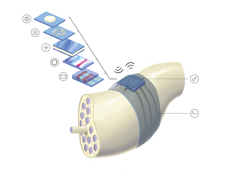 Tiny implants with a compact 3D layout, with all components that give the system its intelligence integrated on the device